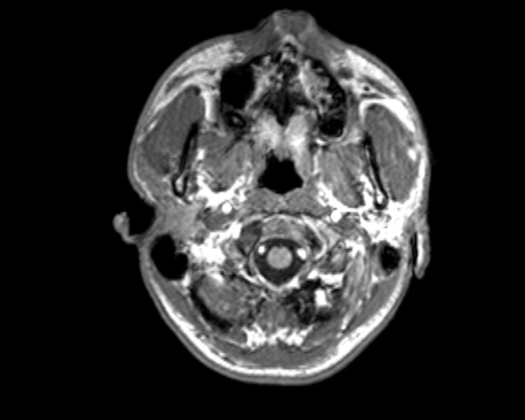 Cerebral arteriovenous malformation (Radiopaedia 30198-30813 Axial T1 52).jpg