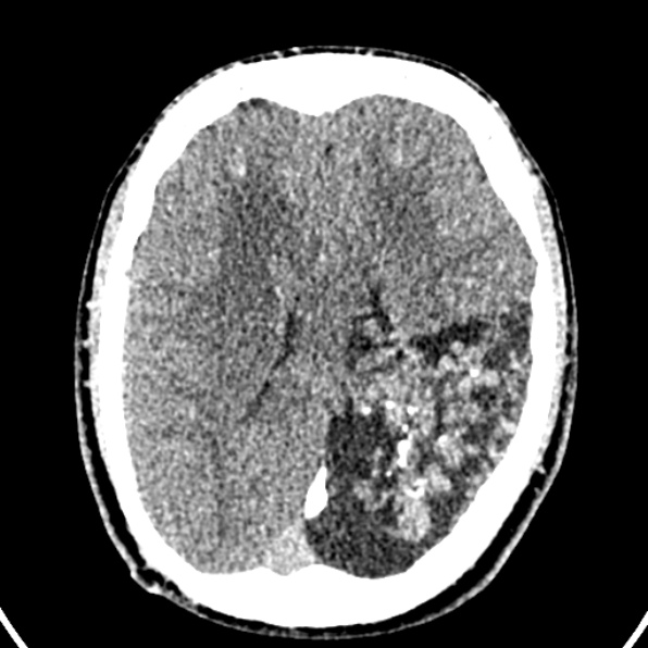 Cerebral arteriovenous malformation (Radiopaedia 37182-39012 Axial non-contrast 31).jpg