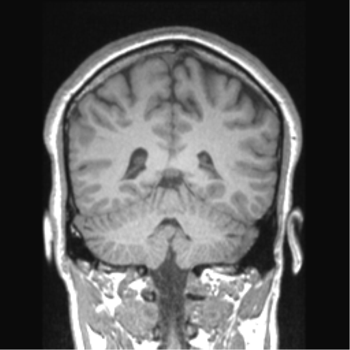 Cerebral arteriovenous malformation (Radiopaedia 39259-41506 Coronal T1 33).png