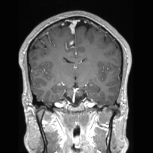 Cerebral arteriovenous malformation (Radiopaedia 39259-41506 Coronal T1 C+ 49).png