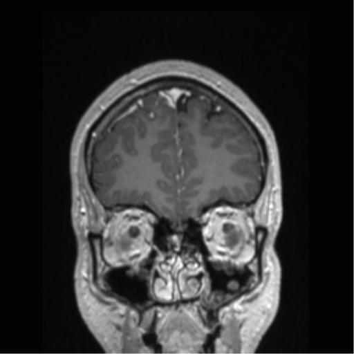 Cerebral arteriovenous malformation (Radiopaedia 39259-41506 Coronal T1 C+ 77).png
