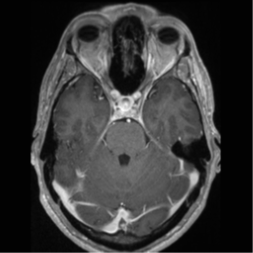 Cerebral arteriovenous malformation (Radiopaedia 55798-62372 Axial T1 C+ 24).png