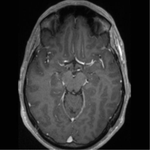 Cerebral arteriovenous malformation (Radiopaedia 55798-62372 Axial T1 C+ 30).png