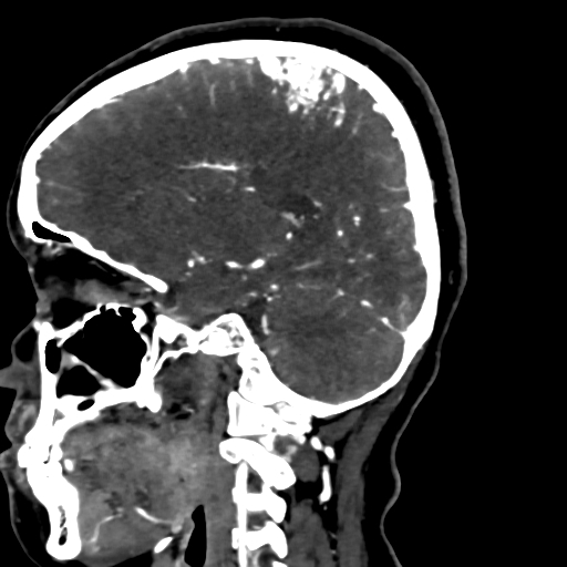Cerebral arteriovenous malformation (Radiopaedia 73830-84645 Sagittal C+ delayed 57).jpg
