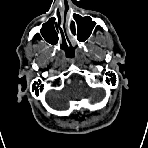 Cerebral arteriovenous malformation (Radiopaedia 78188-90746 Axial C+ delayed 20).jpg