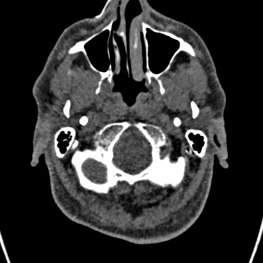File:Cerebral arteriovenous malformation (Radiopaedia 78188-90746 Axial non-contrast 15).jpg