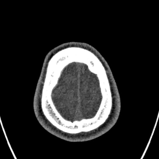 Cerebral arteriovenous malformation (Radiopaedia 78188-90746 Axial non-contrast 165).jpg