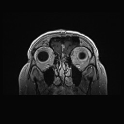 Cerebral arteriovenous malformation (Radiopaedia 84015-99245 Coronal T1 C+ 24).jpg