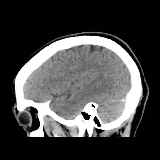 File:Cerebral arteriovenous malformation (Spetzler-Martin grade 2) (Radiopaedia 41262-44076 A 47).png