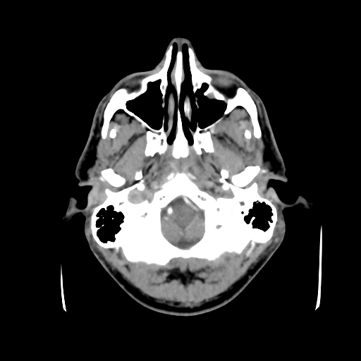 Cerebral arteriovenous malformation (Spetzler-Martin grade 2) (Radiopaedia 41262-44076 Axial C+ 6).png