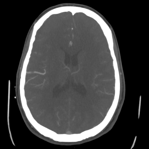 Cerebral arteriovenous malformation (Spetzler-Martin grade 2) (Radiopaedia 41262-44076 E 32).png