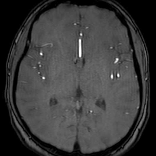 Cerebral arteriovenous malformation at posterior body of corpus callosum (Radiopaedia 74111-84925 Axial MRA 112).jpg