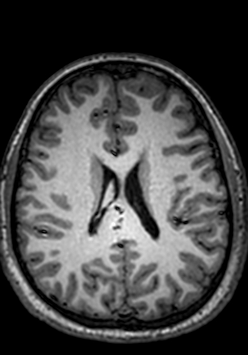 Cerebral arteriovenous malformation at posterior body of corpus callosum (Radiopaedia 74111-84925 Axial T1 108).jpg