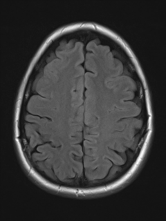 File:Cerebral cavernoma and development venous anomaly (Radiopaedia 37603-39482 Axial FLAIR 17).png