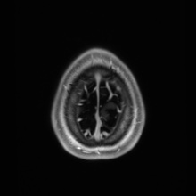File:Cerebral cavernous venous malformation (Radiopaedia 70008-80021 Axial T1 C+ 95).jpg