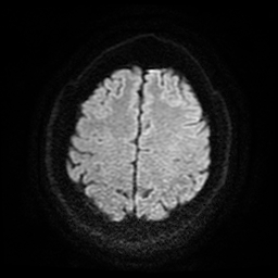 Cerebral cavernous venous malformation (Zabramski type II) (Radiopaedia 85511-101198 Axial DWI 57).jpg