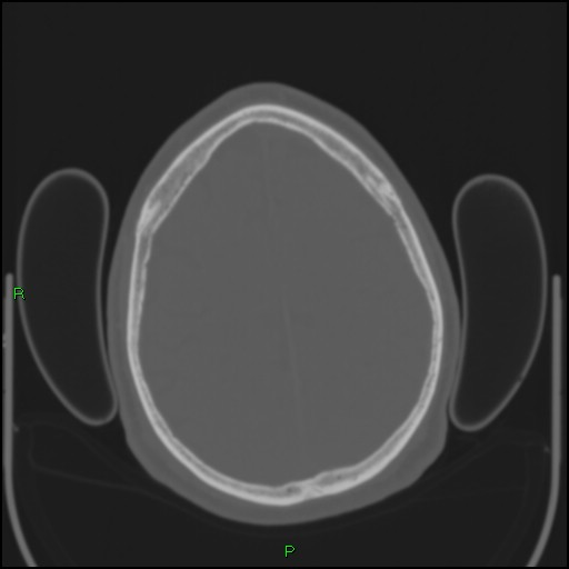 Cerebral contusions (Radiopaedia 33868-35039 Axial bone window 165).jpg