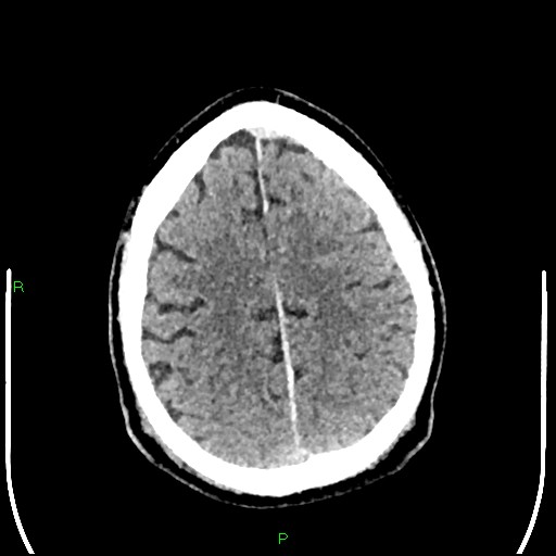 Cerebral contusions (Radiopaedia 33868-35039 Axial non-contrast 167).jpg