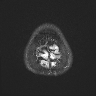 File:Cerebral embolic infarcts (embolic shower) (Radiopaedia 72391-82921 Axial FLAIR 30).jpg
