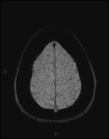 File:Cerebral fat embolism (Radiopaedia 35022-36525 Axial SWI 54).jpg