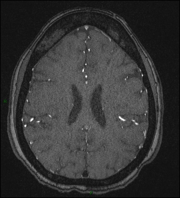 Cerebral fat embolism (Radiopaedia 35022-36525 Axial TOF 135).jpg
