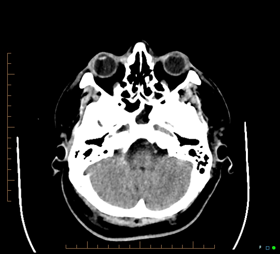 Cerebral fat embolism (Radiopaedia 85521-101220 Axial non-contrast 18).jpg