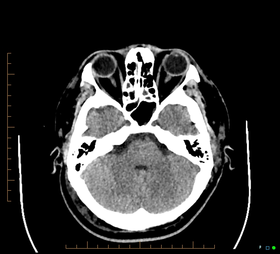 File:Cerebral fat embolism (Radiopaedia 85521-101220 Axial non-contrast 21).jpg