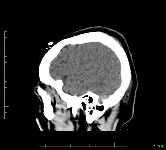 Cerebral fat embolism (Radiopaedia 85521-101220 B 11).jpg