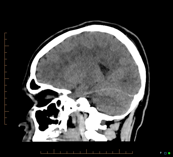 Cerebral fat embolism (Radiopaedia 85521-101220 B 34).jpg