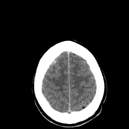 File:Cerebral hemorrhagic contusions- temporal evolution (Radiopaedia 40224-42753 Axial non-contrast 28).png