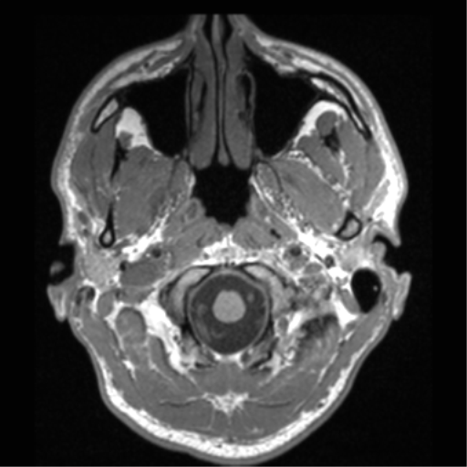 Cerebral hemorrhagic contusions- temporal evolution (Radiopaedia 40224-42757 Axial T1 8).png