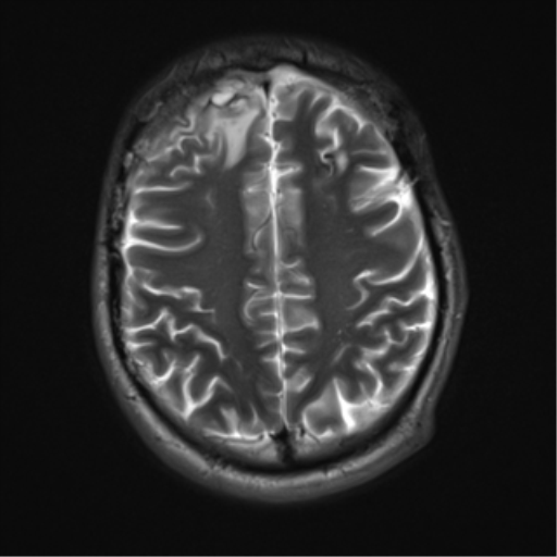 File:Cerebral hemorrhagic contusions- temporal evolution (Radiopaedia 40224-42757 Axial T2 17).png