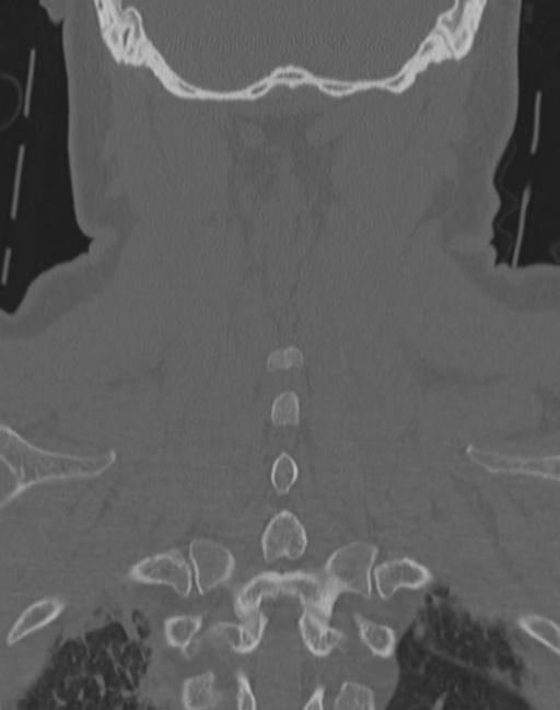 Cerebral hemorrhagic contusions and cervical spine fractures (Radiopaedia 32865-33841 Coronal bone window 61).jpg