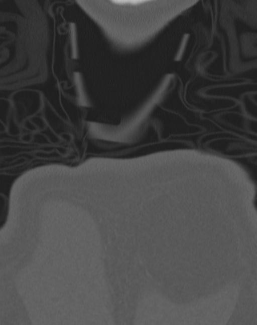 Cerebral hemorrhagic contusions and cervical spine fractures (Radiopaedia 32865-33841 Coronal bone window 95).jpg