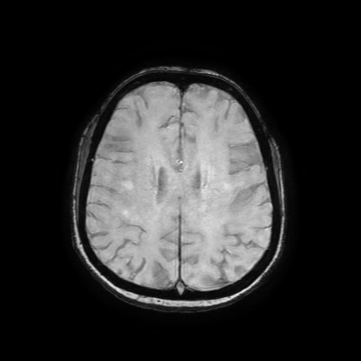 Cerebral metastases - melanoma (Radiopaedia 80972-94522 Axial SWI 67).jpg