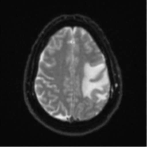 Cerebral metastases mimicking multifocal glioblastoma (Radiopaedia 50843-56353 Axial DWI 20).png