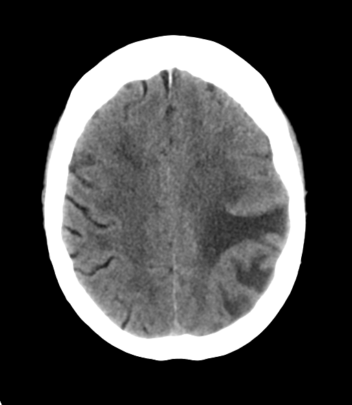 File:Cerebral metastasis (Radiopaedia 46744-51247 Axial non-contrast 22).png
