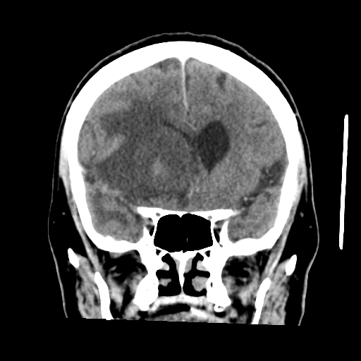 Cerebral metastasis to basal ganglia (Radiopaedia 81568-95412 Coronal C+ delayed 23).png