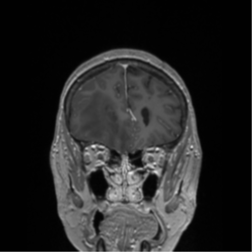 File:Cerebral metastasis to basal ganglia (Radiopaedia 81568-95413 Coronal T1 C+ 49).png