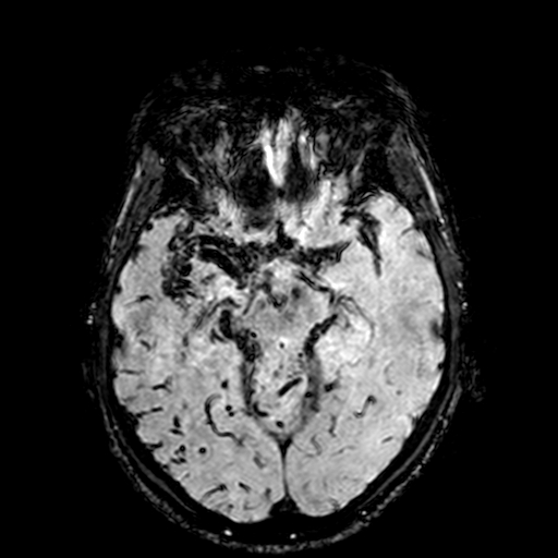 Cerebral parenchymal arteriovenous malformation (Radiopaedia 27280-27456 Axial SWI 42).jpg
