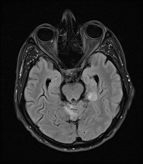 File:Cerebral toxoplasmosis (Radiopaedia 43956-47461 Axial FLAIR 8).jpg