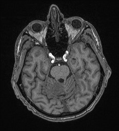 Cerebral toxoplasmosis (Radiopaedia 43956-47461 Axial T1 24).jpg