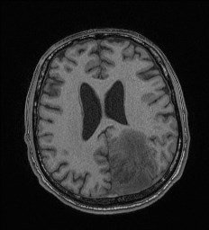 Cerebral toxoplasmosis (Radiopaedia 43956-47461 Axial T1 51).jpg
