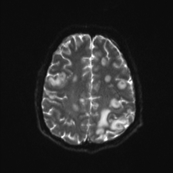 Cerebral toxoplasmosis (Radiopaedia 53993-60132 Axial DWI 20).jpg
