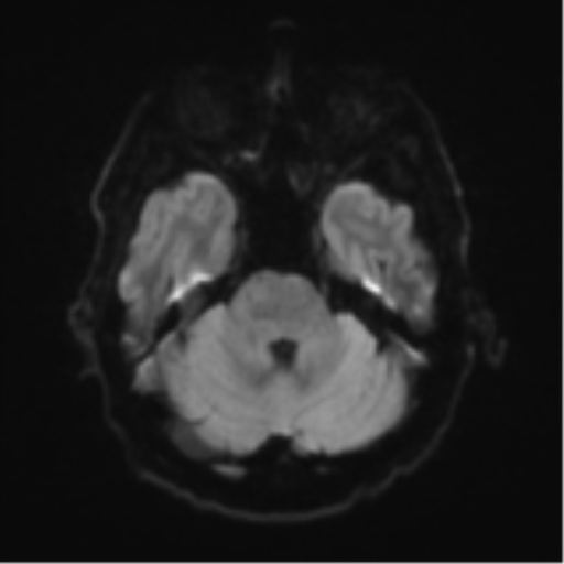 File:Cerebral toxoplasmosis (Radiopaedia 54575-60804 Axial DWI 43).png