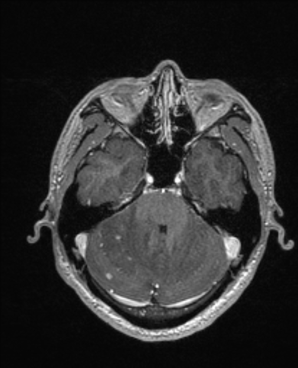 Cerebral toxoplasmosis (Radiopaedia 85779-101597 Axial T1 C+ 47).jpg