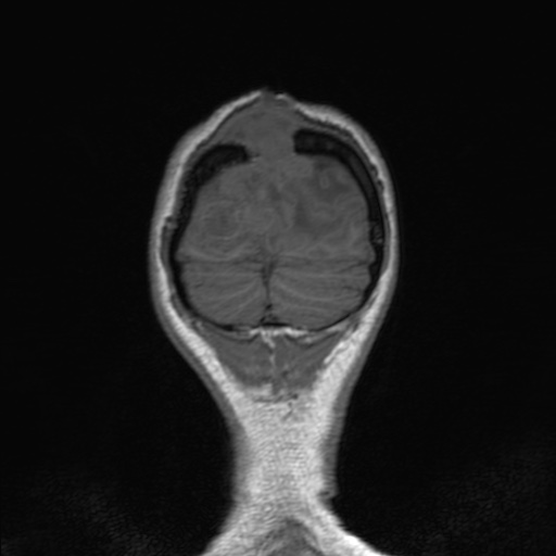 Cerebral tuberculosis with dural sinus invasion (Radiopaedia 60353-68090 Coronal T1 163).jpg