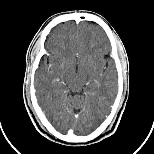 File:Cerebral venous angioma (Radiopaedia 69959-79977 B 34).jpg