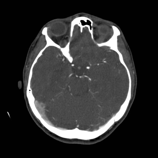 Cerebral venous sinus thrombosis (Radiopaedia 40619-43227 A 83).jpg