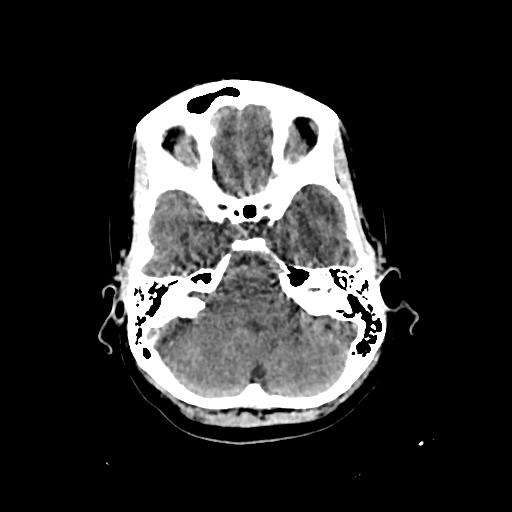 Cerebral venous throbmosis - hemorrhagic venous infarction (Radiopaedia 87318-103613 Axial non-contrast 39).jpg